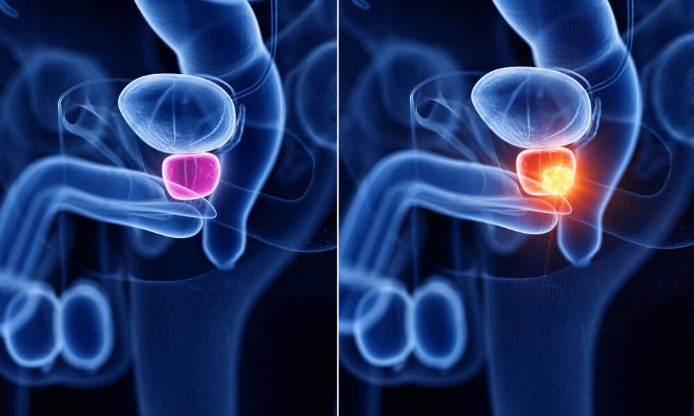 Diese medizinisch korrekt Illustration zeigt, was unbedingt vermieden werden sollte: Links eine gesunde Prostata, rechts mit Krebsgeschwür | © Sebastian Kaulitzki / Adobe Stock