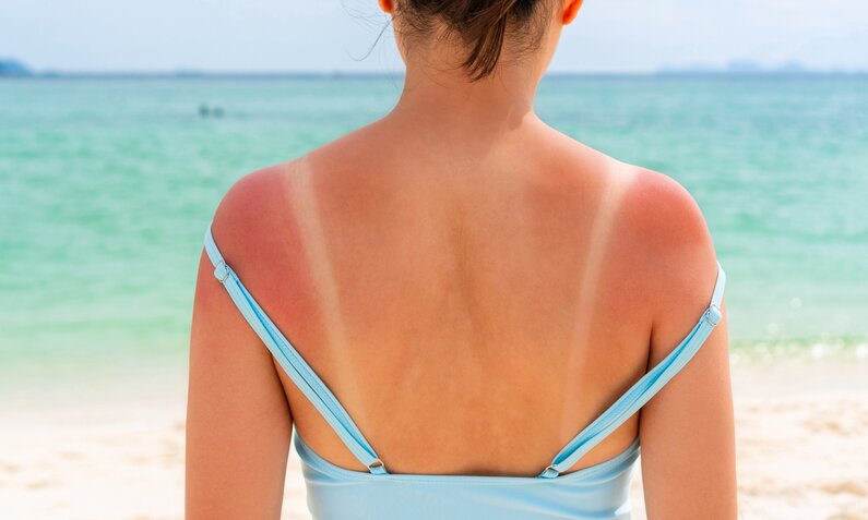 Diese 3 Produkte solltest du bei Sonnenbrand nicht benutzen! | ©  Getty Images / Pattarisara Suvichanarakul